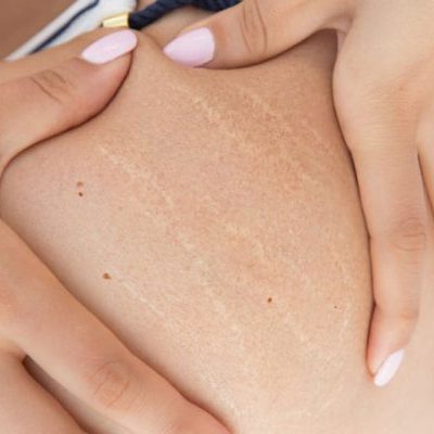 Sam krem najlepiej poprawia… humor. Jak leczy się rozstępy w gabinecie lekarskim