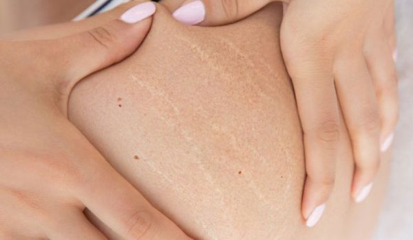 Sam krem najlepiej poprawia… humor. Jak leczy się rozstępy w gabinecie lekarskim