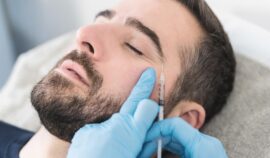 Mężczyzna, który ma wstrzykiwany kwas hialuronowy